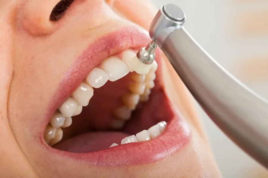 How Often Should You Get Your Teeth Cleaned What Dentists Recommend